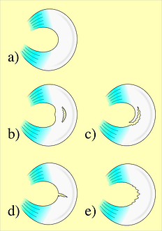 The meniscus is an ear-shaped tissue that protects the knee. When torn, it can lead to pain and arthritis.