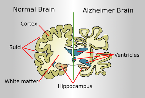 Alzheimer's is a serious disease that greatly affects the brain. 
