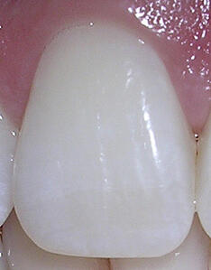 06-10-06rightcentralincisor