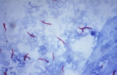 800px-Mycobacterium_tuberculosis_Ziehl-Neelsen_stain_02.jpg