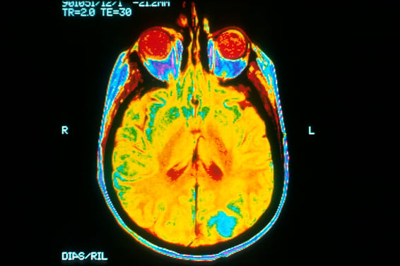 Brain_MRI