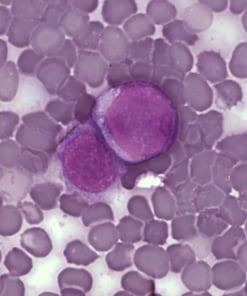 Leukemia_cells