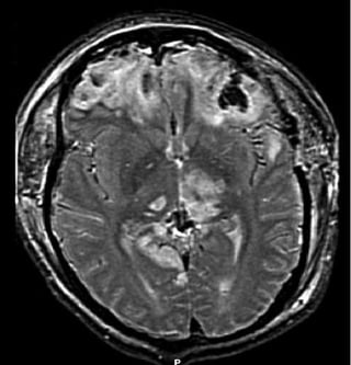 Brain_injury_with_herniation_MRI.jpg