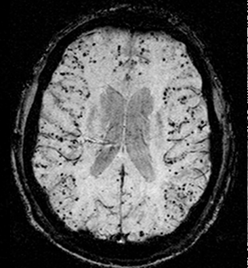 Cerebral_amyloid_angiopathy_(CAA)-MRI-1.png