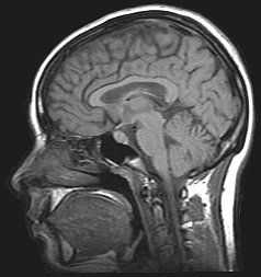 MRI_brain.jpg