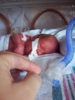 Premature_infant_with_ventilator.jpg