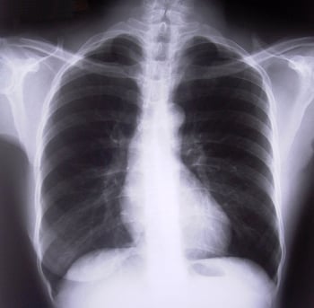 lungxray